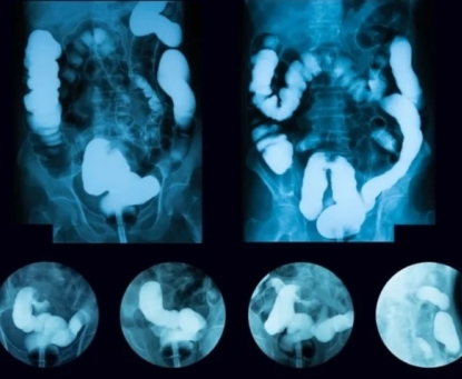 GIST có thể phát hiện thông qua các xét nghiệm hình ảnh nào?